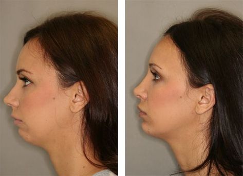 How Much Is a Chin Reduction Surgery?