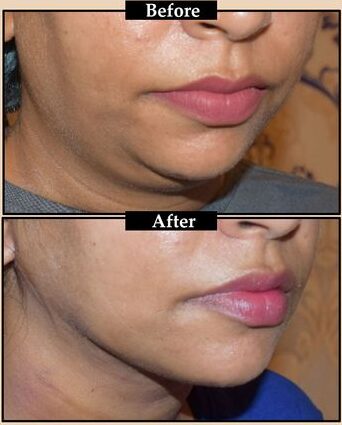 How Much Is a Chin Reduction Surgery?