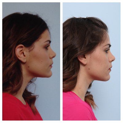 How Much Is a Chin Reduction Surgery?