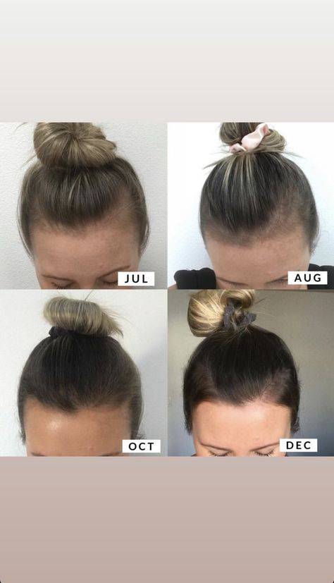 how often to derma roll scalp