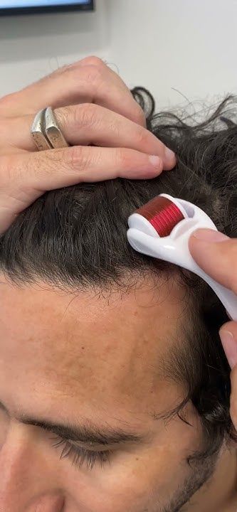 How Often to Dermaroll Scalp?