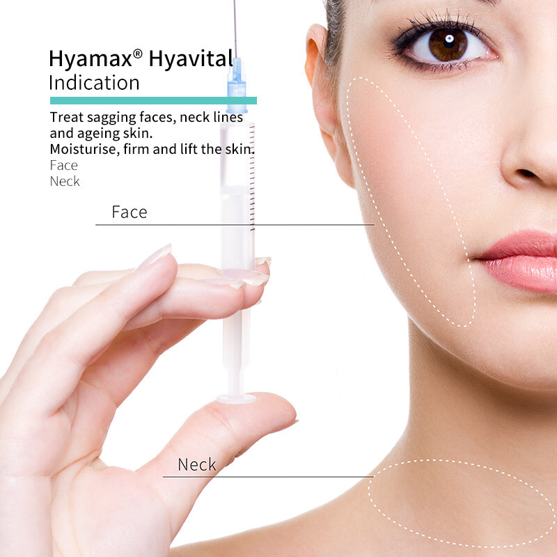 Hyaluronic acid-based fillers tend to attract water