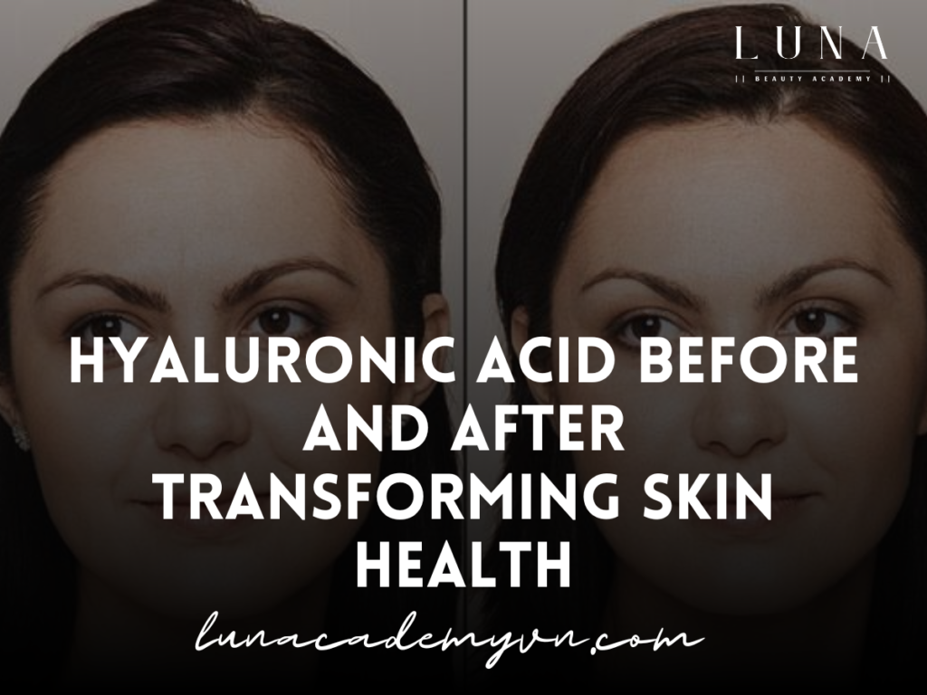 Hyaluronic Acid Before and After Transforming Skin Health