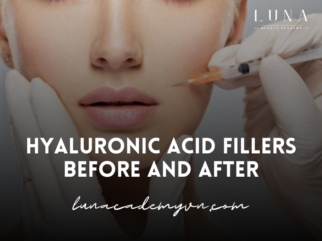 Hyaluronic Acid Fillers Before and After