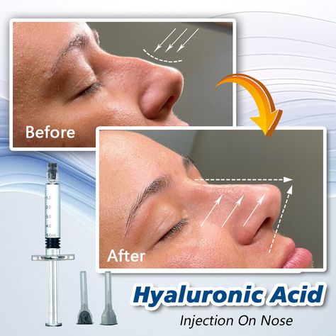 Hyaluronic Acid Fillers Before and After