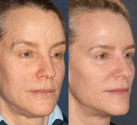 Hyaluronic Acid Fillers Before and After