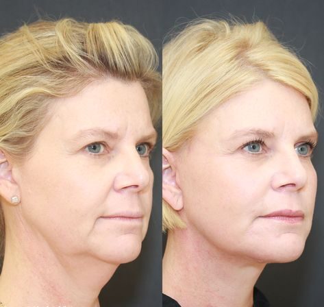 Hyaluronic Acid Fillers Before and After