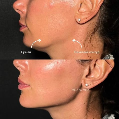 Hyaluronic Acid Fillers Before and After