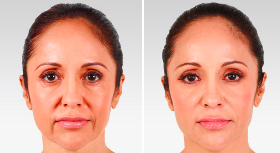 Hyaluronic Acid Fillers (HA) typically last 6-12 months