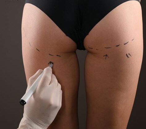 Hyaluronic Acid Injections in Buttocks: A Comprehensive Guide