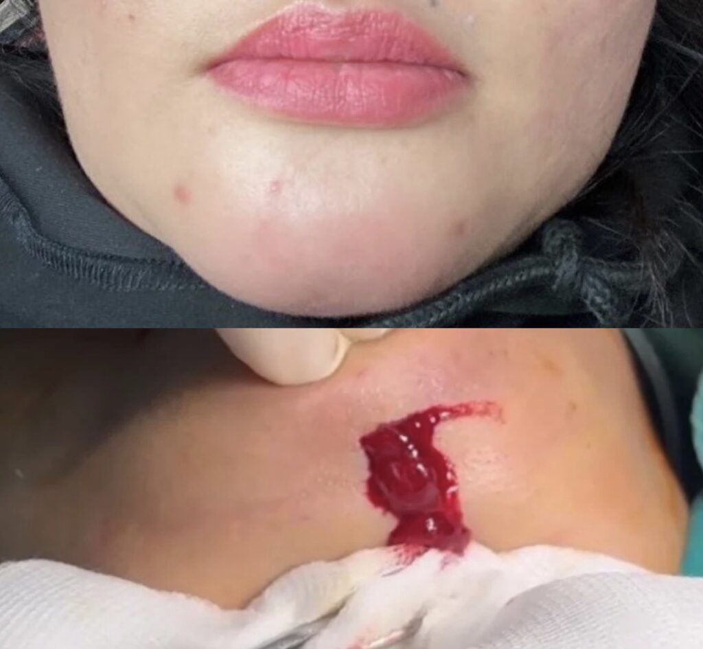 Infection after facial filler injection