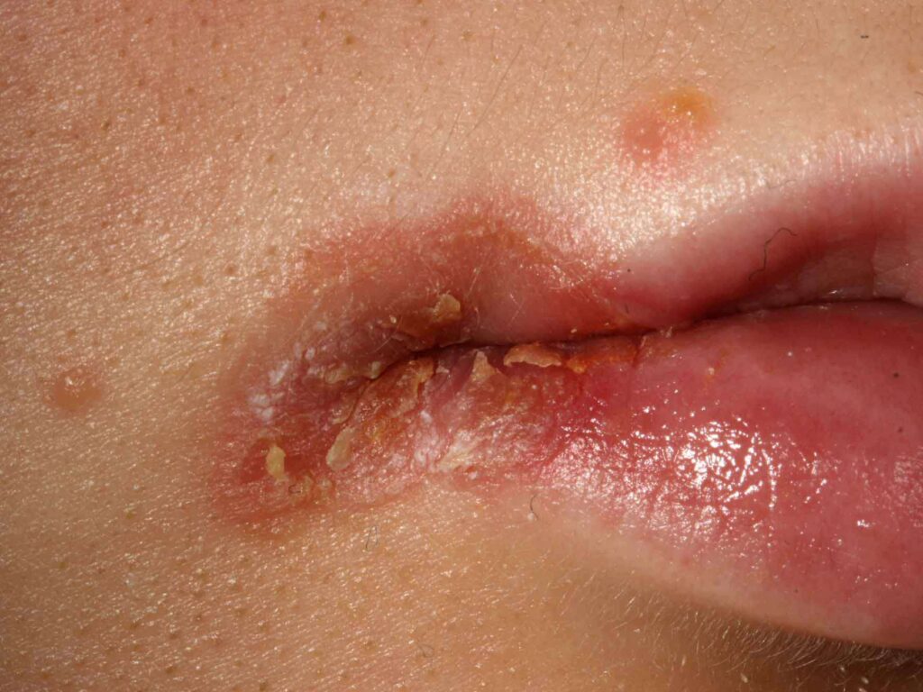 Inflammation and Peeling lips