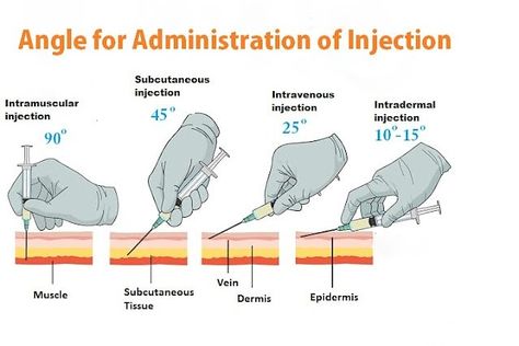 Intradermal Needle Gauge