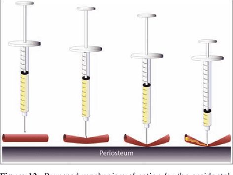 Intradermal Needle Size and Gauge