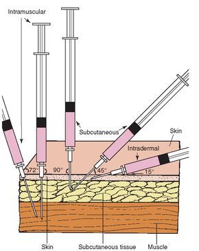 Intradermal Needle Size and Gauge