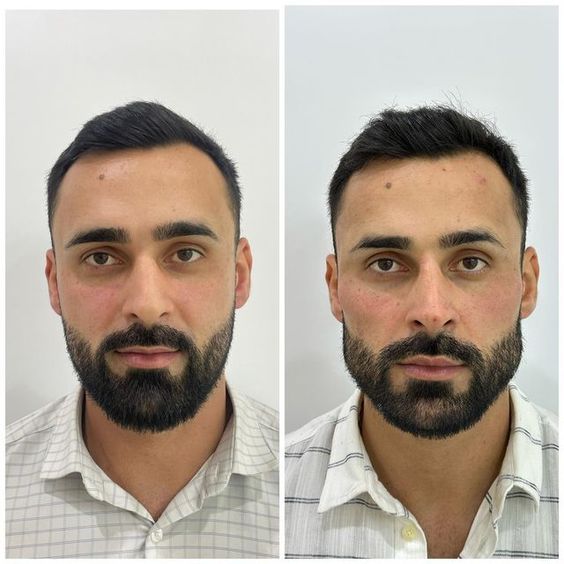 Jawline Filler Men Before and After