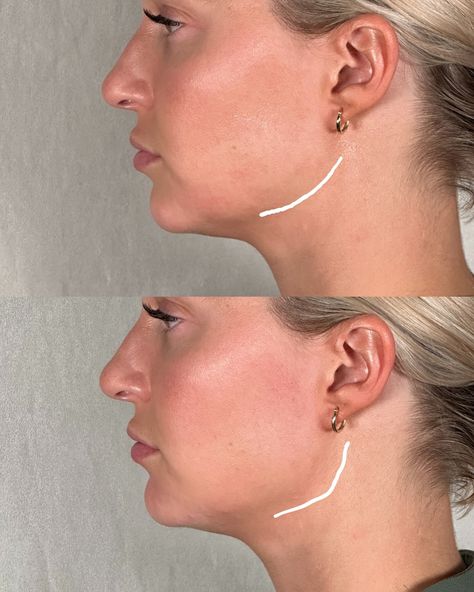 Jawline Filler Price: What You Need to Know