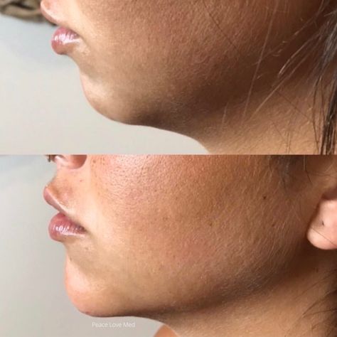 Jawline Filler Price: What You Need to Know