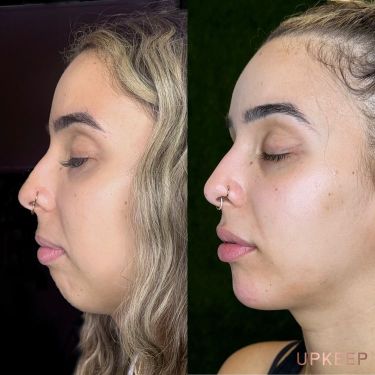 Jawline Filler Price: What You Need to Know