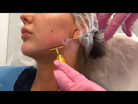 Jawline Filler Price: What You Need to Know