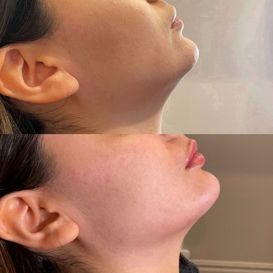 Jawline Filler results