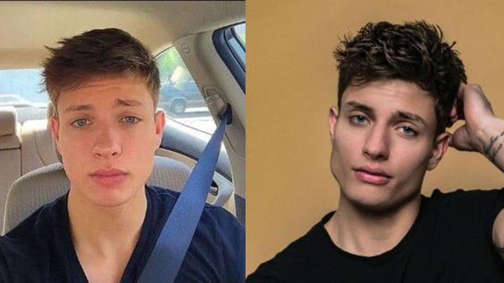 Jawline Fillers Before and After