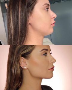 Jawline Fillers Cost: A Comprehensive Guide