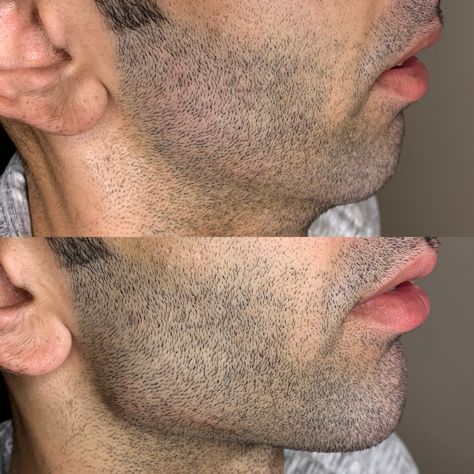 Jawline Fillers Cost: A Comprehensive Guide