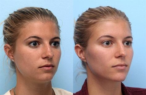 Jawline Injections Cost: A Comprehensive Guide