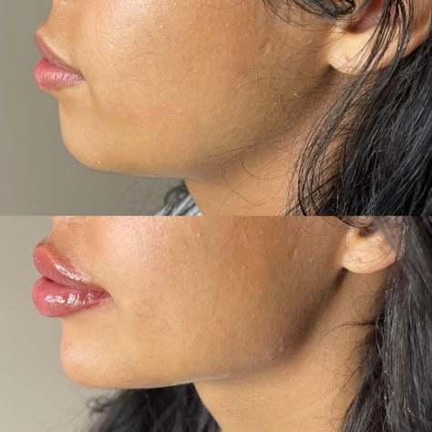 Jawline Injections Cost: A Comprehensive Guide