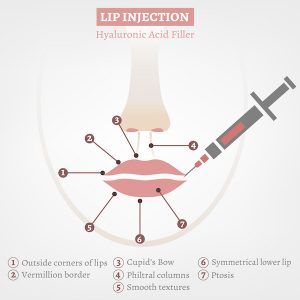 Lip Filler 2ml – You Need to Know About the Perfect Volume 