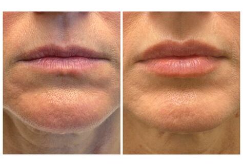 Lip Filler 2ml – You Need to Know About the Perfect Volume