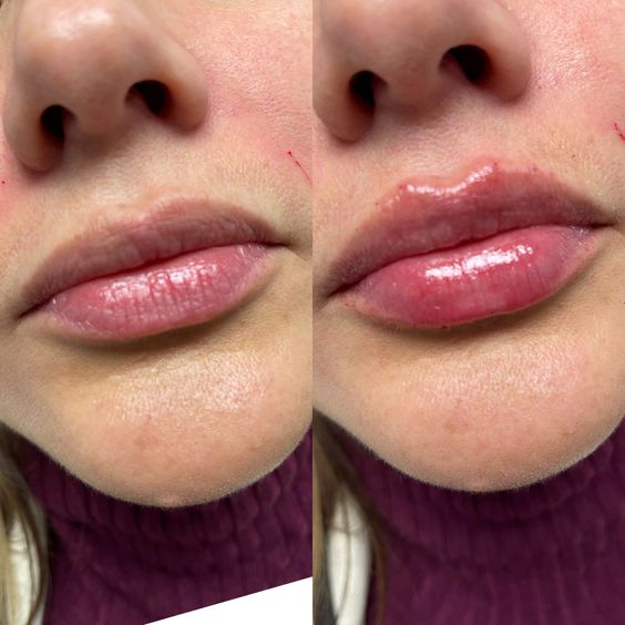 Lip Filler 2ml – You Need to Know About the Perfect Volume 