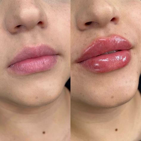 Lip Filler 2ml – You Need to Know About the Perfect Volume 