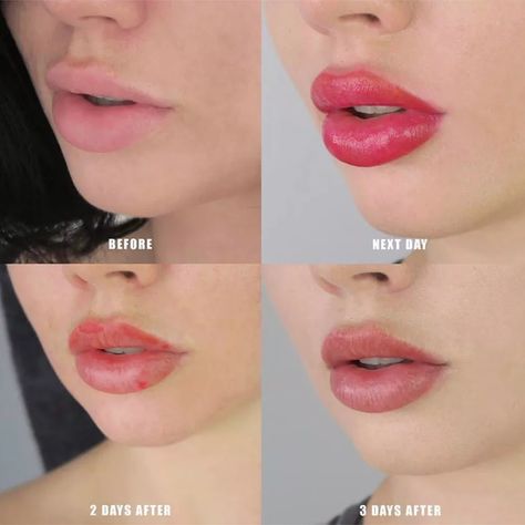 Lip Filler Dos and Don'ts