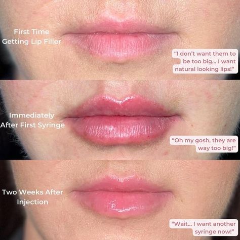 Lip Filler Dos and Don'ts