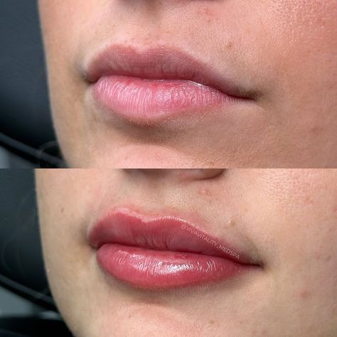 Lip Filler Dos and Don'ts