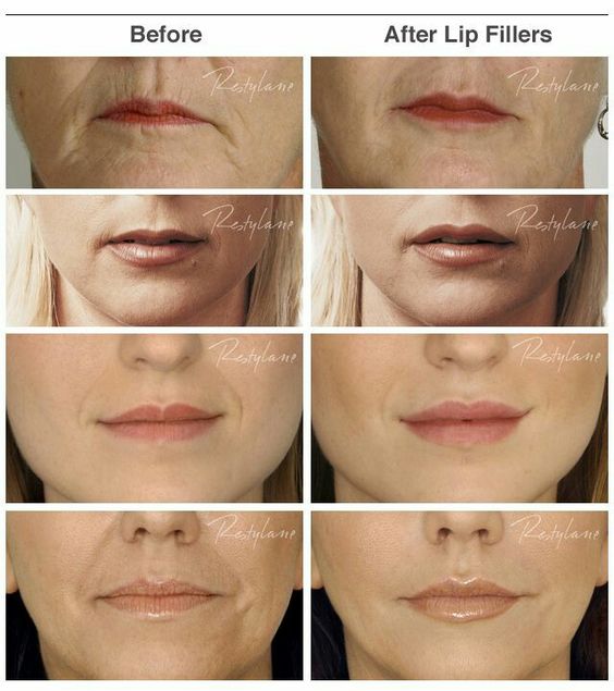 Lip Filler Price Range