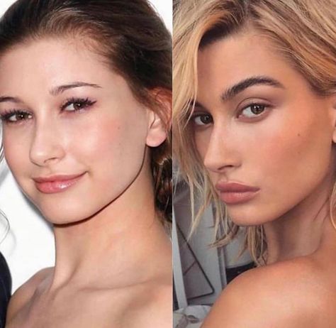 Lip Fillers Dos and Don'ts: A Comprehensive Guide