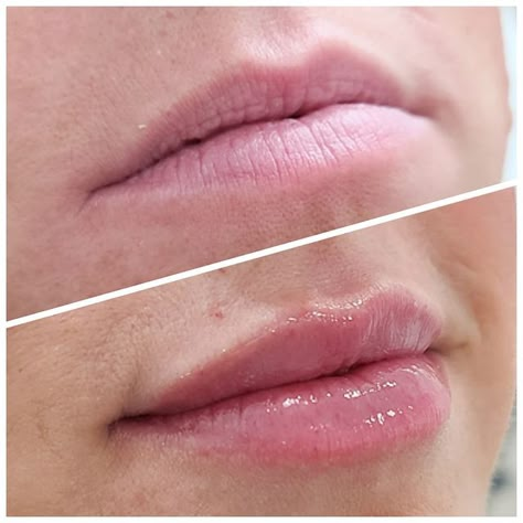 Lip Fillers Dos and Don’ts After: Post-Procedure Care