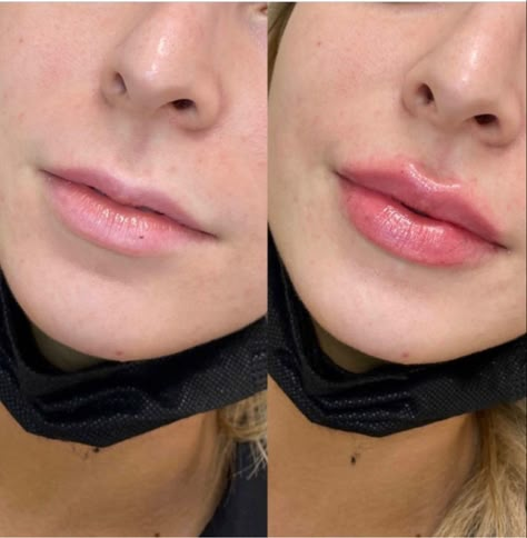 Lip Fillers on Small Lips: A Comprehensive Guide