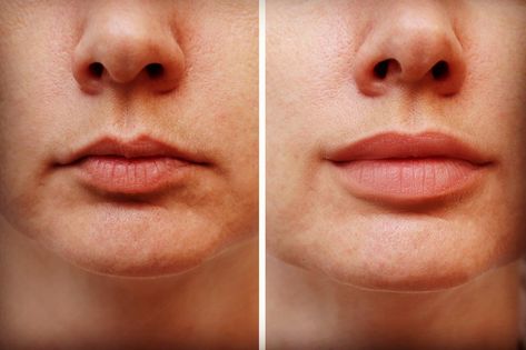 Lip Fillers on Small Lips: A Comprehensive Guide