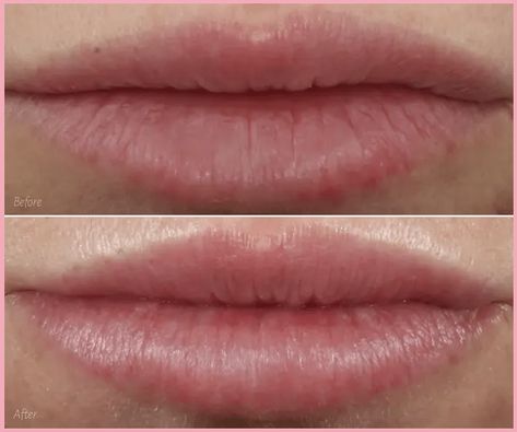 Lip Fillers on Small Lips: A Comprehensive Guide