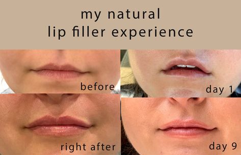 Lip Fillers on Small Lips: A Comprehensive Guide