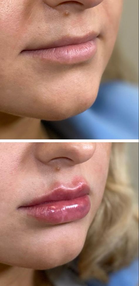 Lip Fillers Portland: Fuller, Plumper Lips