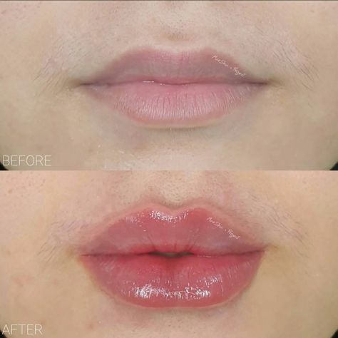 Lip Fillers Portland: Fuller, Plumper Lips