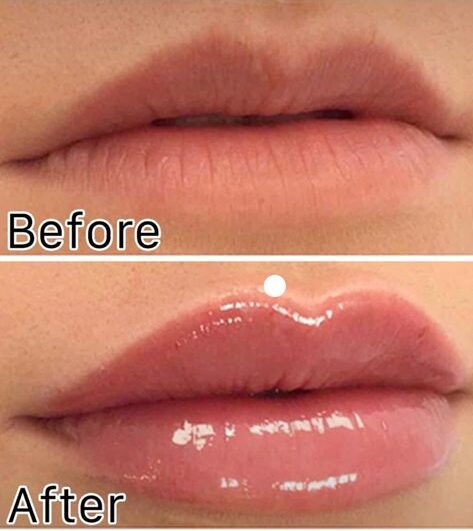 Lip Fillers Portland: Fuller, Plumper Lips