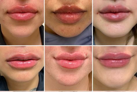 Lip Fillers Portland: Fuller, Plumper Lips