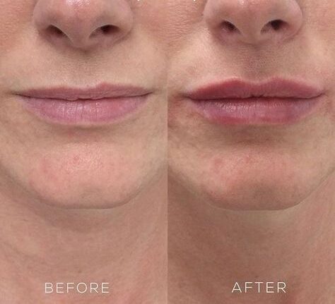 Lip Fillers Portland: Fuller, Plumper Lips