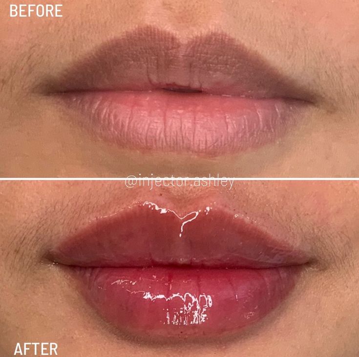 Lip Fillers Portland: Fuller, Plumper Lips